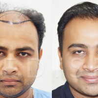 Medispa Hair Transplant, Jaipur, India