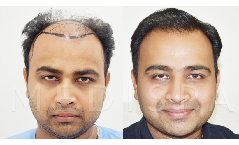 Celebrity Hair Transplant in Jaipur India