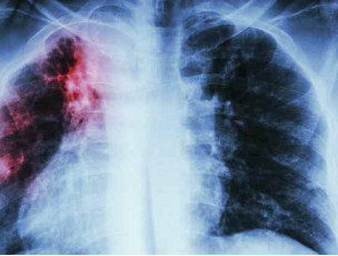 Interestional Lung Disease Treatment
