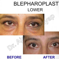 Blepharoplasty Surgery Delhi India