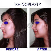 Blepharoplasty Surgery Delhi India